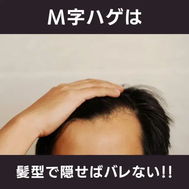 【薄毛隠しの秘密】M字ハゲをカバーする髪型で自分に自信を持とう! image